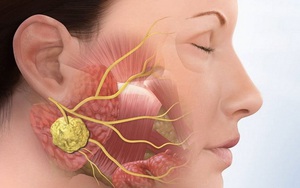 Phân biệt bệnh quai bị và viêm tuyến nước bọt