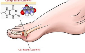 Xử trí tăng acid uric máu