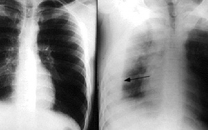 Vì sao bị tràn dịch màng phổi?