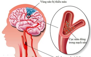 Cảnh giác với cơn thiếu máu não thoáng qua