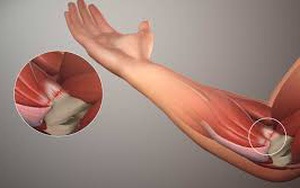 Đau khớp khuỷu tay: Nguyên nhân và cách xử trí