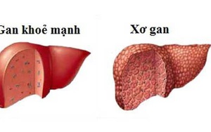 Bệnh xơ gan cần kiêng gì?