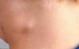 Tiếp xúc với người mắc lao hạch có đáng lo?