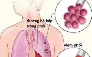 6 bệnh viêm phổi - phế quản thường gặp