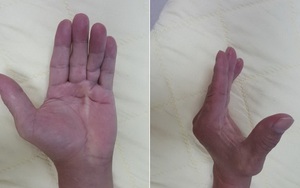 Làm gì khi bị đau co rút bàn tay?