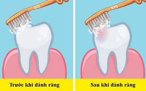 Các nha sĩ trả lời câu hỏi "dễ mà khó": Nên đánh răng trước hay sau bữa ăn sáng?