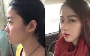 Khóc 3 ngày 3 đêm vì quá đau, gái xinh vẫn khẳng định không hề hối hận khi phẫu thuật thẩm mỹ