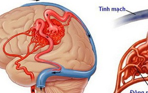 Từ ca bệnh 10 tuổi đã đột quỵ: CT Hội Phòng chống Đột quỵ chỉ ra dấu hiệu đau đầu nguy hiểm