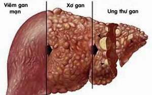 Người phụ nữ mắc ung thư gan điều trị 8 năm đã ổn định: "Bí quyết" thành công là gì?