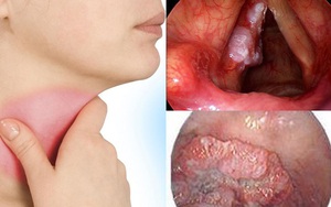 Nhận biết dấu hiệu ung thư thanh quản để không bỏ lỡ 'thời gian vàng' điều trị