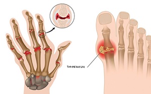 Gout - căn bệnh của giới nhà giàu?