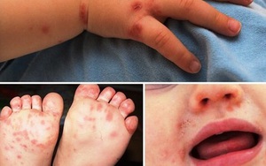 Bệnh tay chân miệng trẻ em bùng phát ở Lâm Đồng