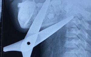 Bé trai 7 tuổi bị kéo đâm xuyên cổ khi cắt giấy làm diều