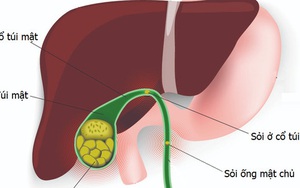 Nhận diện và xử trí kịp thời sỏi túi mật