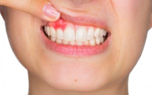 Viêm nướu răng nguy hiểm thế nào?