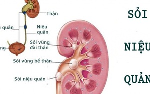 Sỏi niệu quản có nguy hiểm?