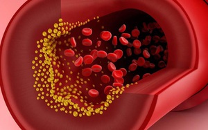 Mỡ máu cao có thể dẫn đến tắc mạch máu, đột tử: 4 "sát thủ" tàng hình bạn nên tránh xa