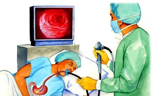 Nội soi dạ dày có nên gây mê?