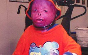 Cậu bé từng bị bỏng 95% cơ thể, trải qua 87 cuộc phẫu thuật đau đớn, bị gọi là người ngoài hành tinh bây giờ ra sao sau nhiều năm?