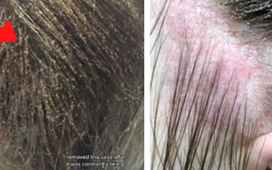 Mang quả đầu đỏ rát, lúc nhúc hàng ngàn con chấy đến salon, cô bé khiến chuyên gia khóc thét vì sốc và kết quả đáng kinh ngạc sau đó