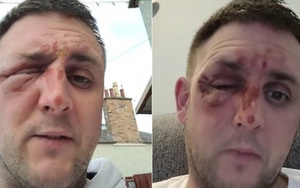 Nấu trứng bằng lò vi sóng theo công thức trên TikTok, người đàn ông bỏng nặng vùng mặt