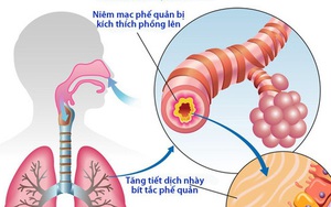 Món ăn, bài thuốc trị viêm phế quản tái phát trong mùa đông