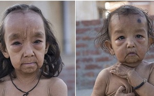 Hai chị em ruột cùng bị bệnh siêu lão hóa từ lúc còn bé thơ, cuộc sống bi kịch khiến ai cũng xót xa