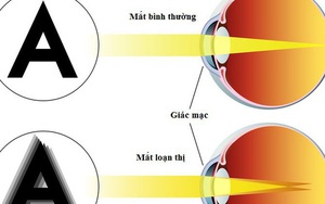 Loạn thị có chữa được không? Điều trị loạn thị như nào?