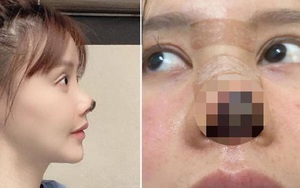 Nữ diễn viên Trung Quốc phẫu thuật thẩm mỹ tới nỗi rụng cả mũi, ngượng không dám thò mặt ra đường