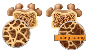 Nhận biết sớm bệnh loãng xương