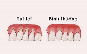 Hậu quả đáng ngại khi bị tụt lợi