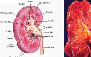 Bài thuốc hỗ trợ trị viêm cầu thận cấp