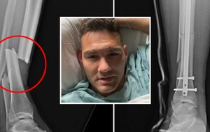 Xót xa trước hình ảnh chụp X-quang chấn thương gãy chân kinh hoàng của Chris Weidman