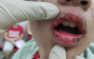 Thiếu nữ 15 tuổi lở loét môi sau khi bôi son