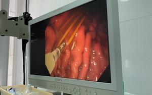 Lấy cùng lúc 3 cây tăm tre trong dạ dày bệnh nhân