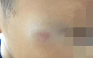 Cậu bé tiểu học bị cô giáo đánh tím mặt: Cô bị đình chỉ ngay lập tức nhưng hành động trước đó của đứa trẻ khiến MXH tranh cãi