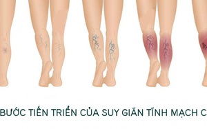 Bài tập cho người suy giãn tĩnh mạch chân