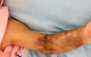Bé trai 1 tháng tuổi bị hoại tử cánh tay do mắc hội chứng chèn ép khoang