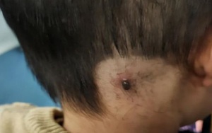 Phát hiện cục thịt dư đen thui sau gáy con, mẹ làm ngay 3 việc, bác sĩ biết chuyện khen nức nở