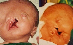 Bé trai sinh ra với 2 khuôn mặt dính liền nhau, bác sĩ khẳng định khó sống sót nhưng diện mạo và cuộc sống sau 17 năm gây kinh ngạc