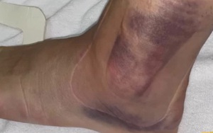1 ngày sau chấn thương kinh hoàng của Ceballos: Cổ chân bầm tím, sưng tấy gây sợ hãi