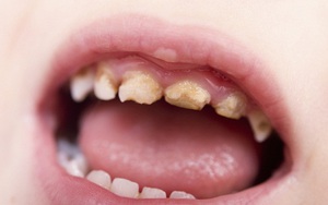 7 thói quen gây hại cho răng ai cũng nên biết