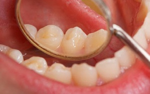 Các yếu tố nguy cơ gây ung thư miệng
