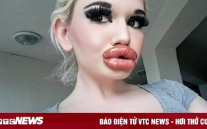 Cô gái tiêm môi 32 lần bất chấp nguy hiểm tính mạng