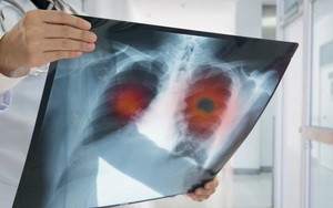 Thói quen này của 1,1 tỷ người trên thế giới là nguyên nhân gây ra 90% các bệnh về phổi