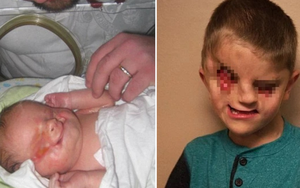 Bé trai sinh ra hoàn toàn không có mắt bị kỳ thị là "dị nhân", cuộc sống khi lớn lên sau 7 ca phẫu thuật khiến người đời khâm phục