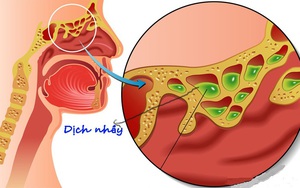 8 biện pháp làm giảm ngạt mũi cho F0