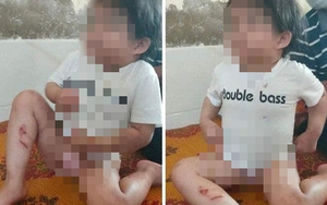 Vụ bé 4 tuổi bị bạo hành: Công an tạm giữ dì ruột để điều tra