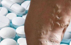 Thiếu hụt hai loại vitamin này có thể gây giãn tĩnh mạch, ảnh hưởng tới đông máu