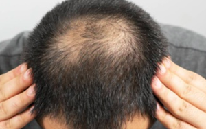 Đàn ông hói đầu có phải liên quan đến vấn đề sinh lý?